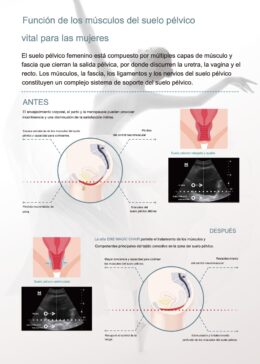 EMSella - Pelvic Chair - Imagen 4